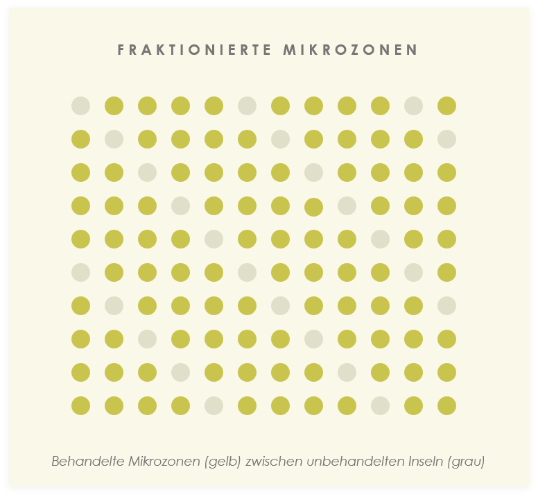 Fraktionierter 1550-nm-Laser Mosaic 3D – Wirkprinzip in der Dermis